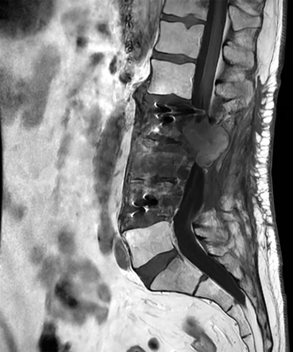 CS_ARDL - spine tumor_Fig2 A.jpg