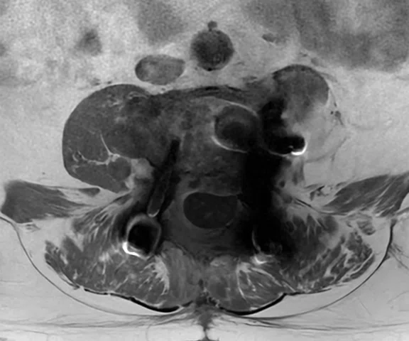 CS_ARDL - spine tumor_Fig2 B.jpg