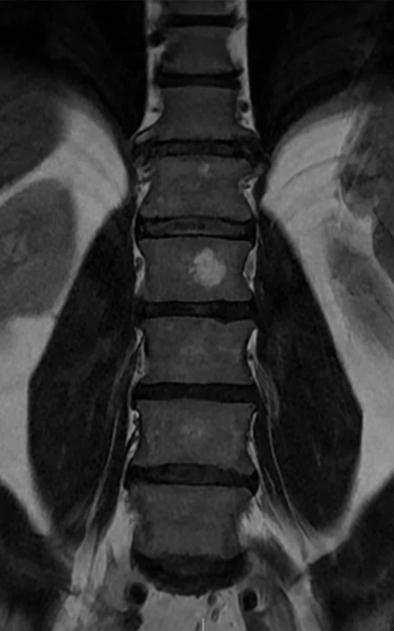 CS_ARDL - spine tumor_Fig4 A.jpg