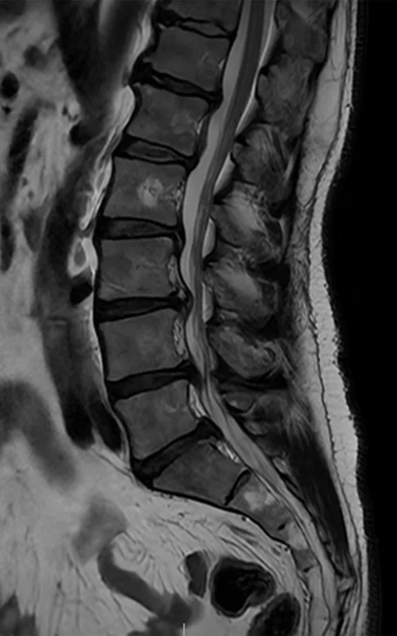 CS_ARDL - spine tumor_Fig4 B.jpg