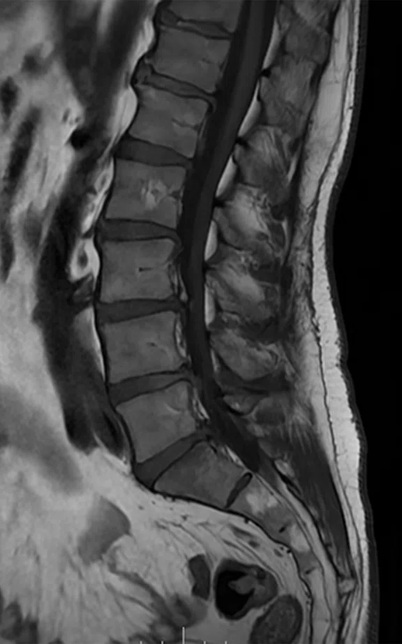 CS_ARDL - spine tumor_Fig4 C.jpg