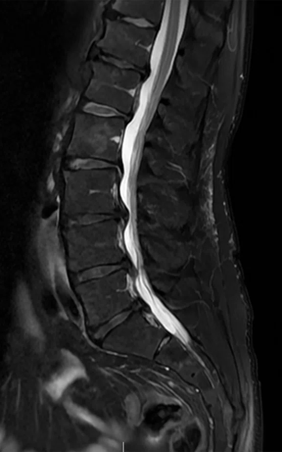 CS_ARDL - spine tumor_Fig4 D.jpg