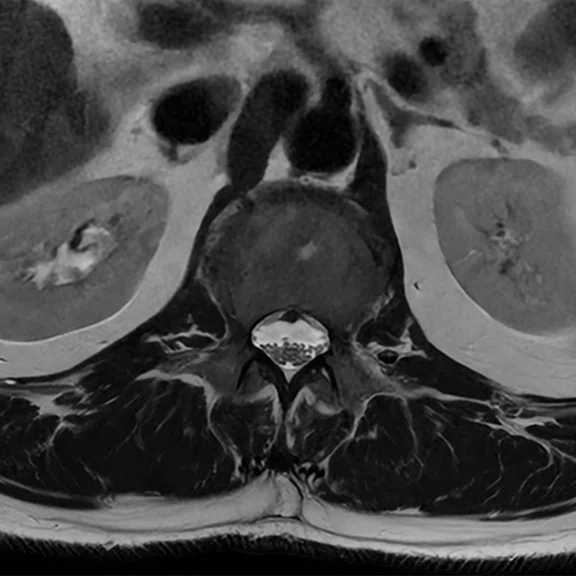 CS_ARDL - spine tumor_Fig4 E.jpg