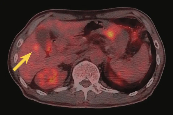 CS_PET:MR breast and liver_Fig1 D.jpg