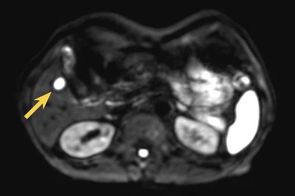 CS_PET:MR breast and liver_Fig2 D.jpg