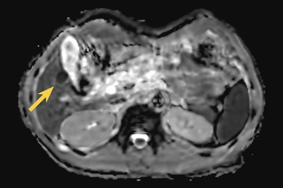 CS_PET:MR breast and liver_Fig2 F.jpg