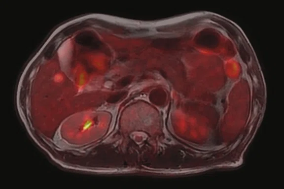 CS_PET:MR breast and liver_Fig3 B.jpg