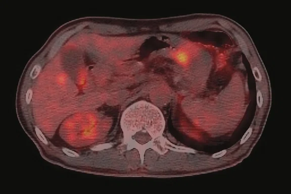CS_PET:MR breast and liver_Fig3 D.jpg