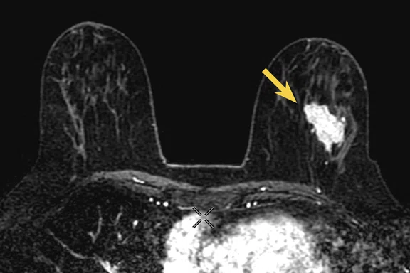 CS_PET:MR breast and liver_Fig4 C.jpg