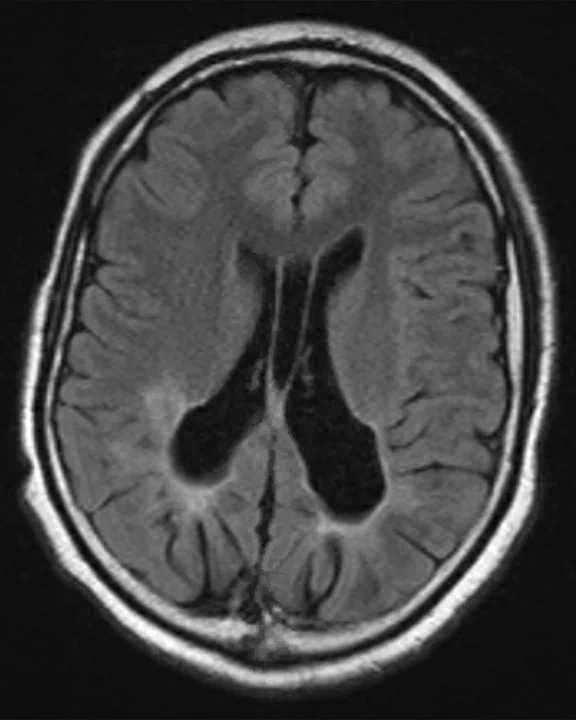 CS_Neuro ALD Fig_1A.jpg