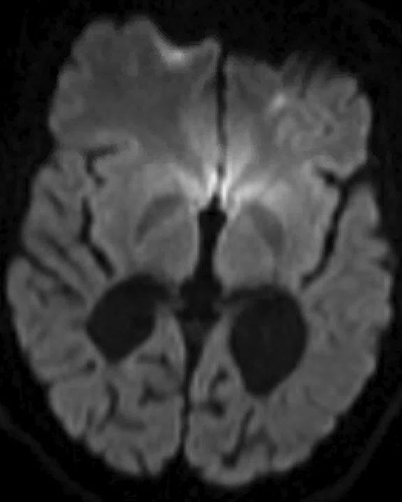 CS_Neuro ALD Fig_1E.jpg