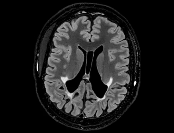 CS_Neuro ALD Fig_2A.jpg