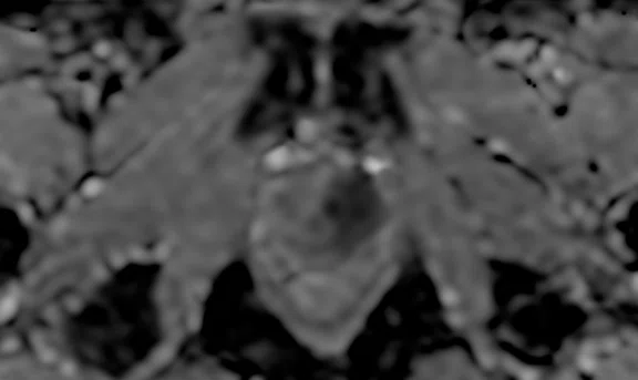 IP_Voyager Prostate (RMI)_image3 NEW 2F Fig 2F.jpg