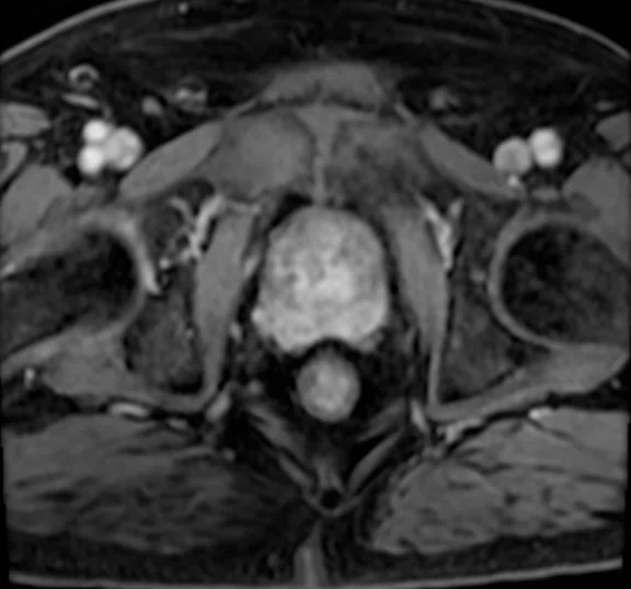 IP_Voyager Prostate (RMI)_image20 Fig 3F.jpg