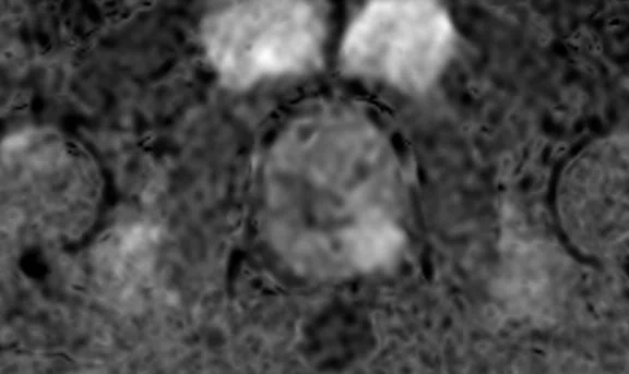 IP_Voyager Prostate (RMI)_image24 Fig 4D.jpg