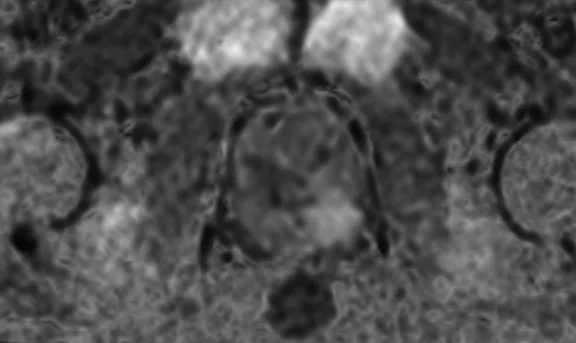IP_Voyager Prostate (RMI)_image25 Fig 4E.jpg