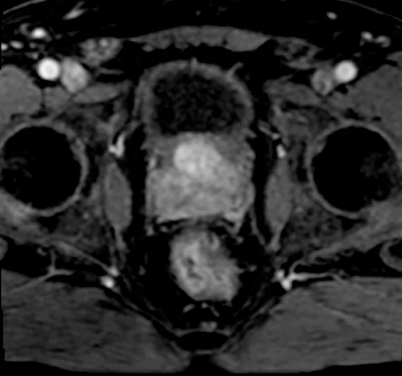 IP_Voyager Prostate (RMI)_image29 FIG 5F.jpg