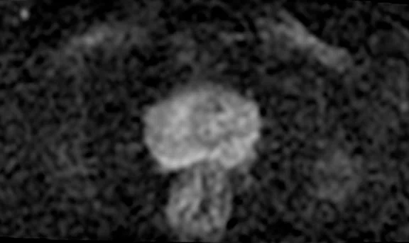IP_Voyager Prostate (RMI)_image34 FIG 6B.jpg