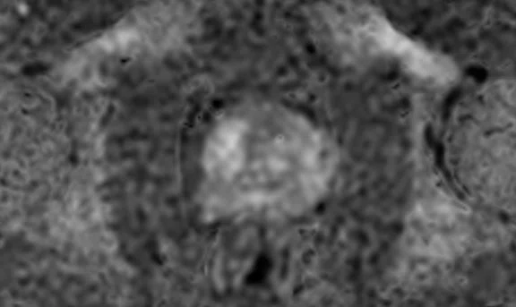 IP_Voyager Prostate (RMI)_image37 FIG 6D.jpg