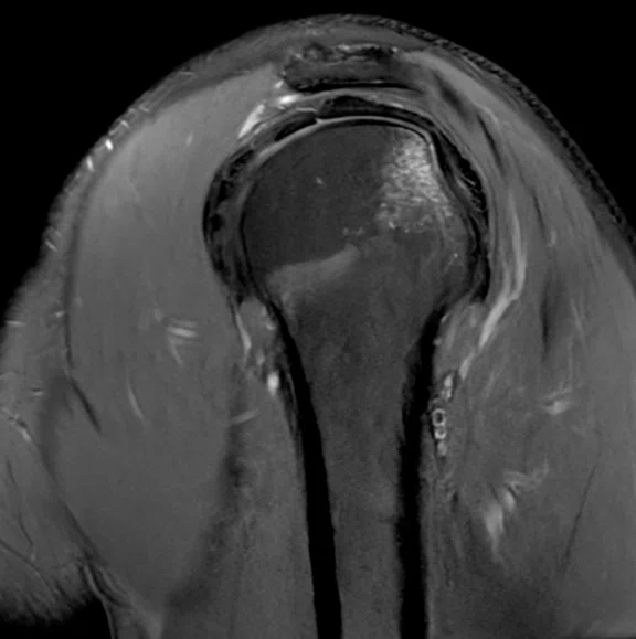 IP_Shoulder Arthrography_image2 Fig 2A.jpg