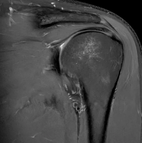 IP_Shoulder Arthrography_image3 Fig 2B.jpg