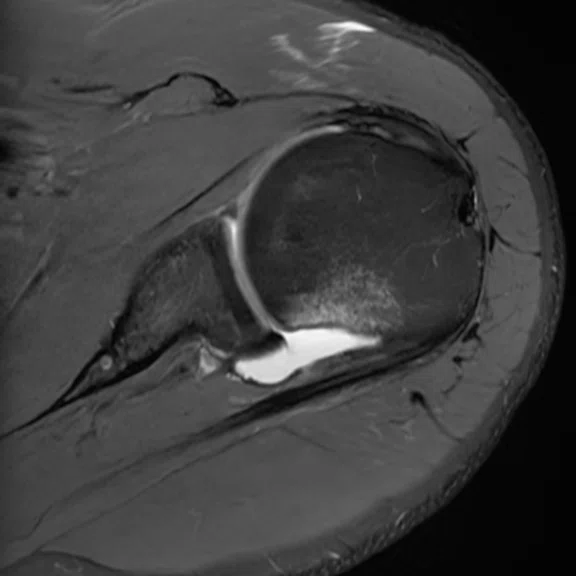 IP_Shoulder Arthrography_image4 Fig 3A.jpg