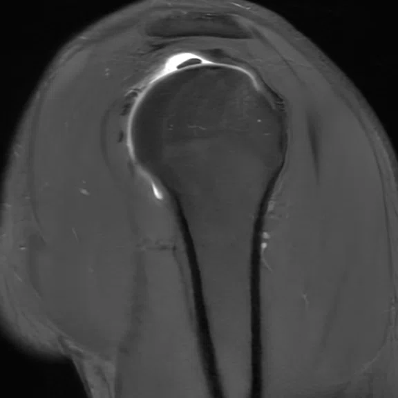 IP_Shoulder Arthrography_image5 Fig 3B.jpg