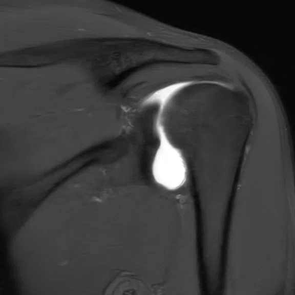 IP_Shoulder Arthrography_image6 Fig 3C.jpg