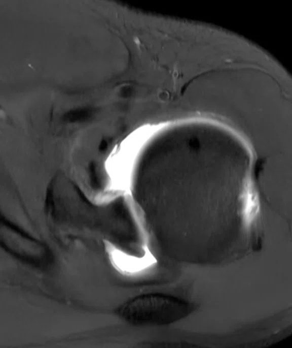 IP_Shoulder Arthrography_image9 Fig 4B.jpg