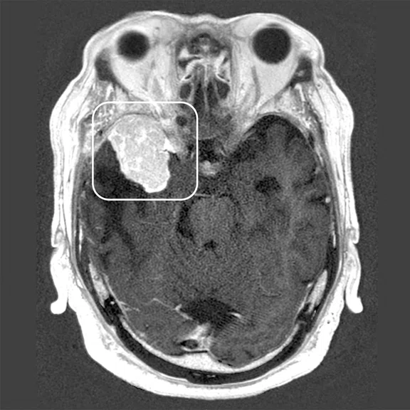  CS_ASL PSIR UOUH Japan_image17 Fig 3A.jpg