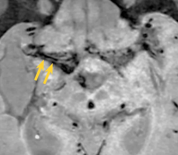 CS_Moyamoya Premier_image6 Fig 1D.jpg