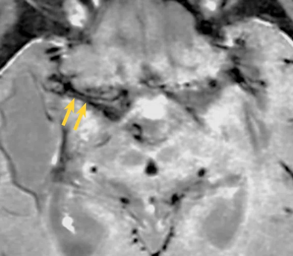 CS_Moyamoya Premier_image5 Fig 1E.jpg