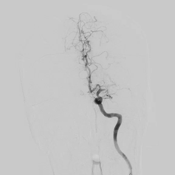 CS_3D ASL stroke_image7 Fig 2A.jpg