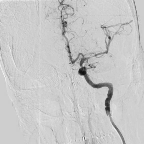 CS_3D ASL stroke_image8 Fig 2B.jpg