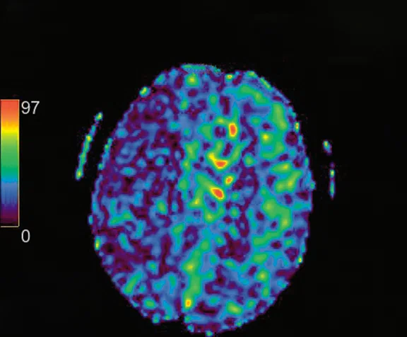 CS_3D ASL stroke_image9 Fig 3A.jpg