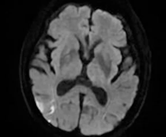 CS_3D ASL stroke_image10 Fig 3B.jpg