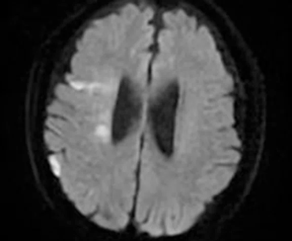 CS_3D ASL stroke_image11 Fig 3C.jpg