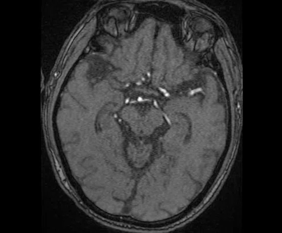 CS_3D ASL stroke_image12 Fig 3D.jpg