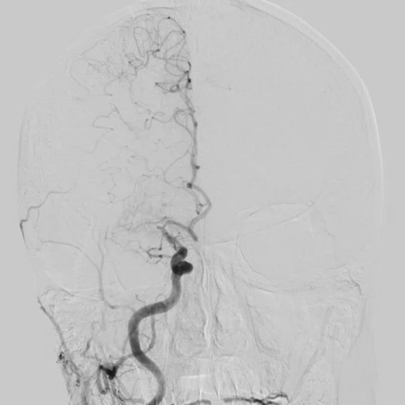 CS_3D ASL stroke_image13 Fig 4A.jpg