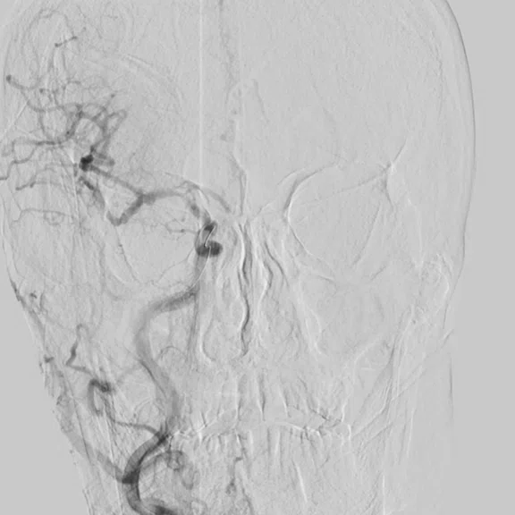 CS_3D ASL stroke_image14 Fig 4B.jpg