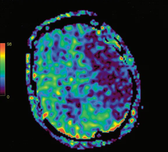 CS_3D ASL stroke_image1 Fig 1A.jpg