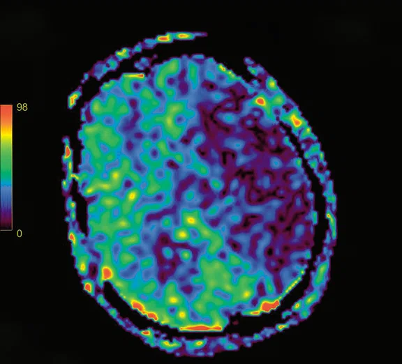 CS_3D ASL stroke_image2 Fig 1B.jpg