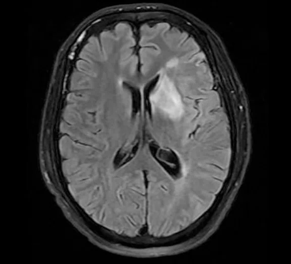 CS_3D ASL stroke_image3 Fig 1C.jpg