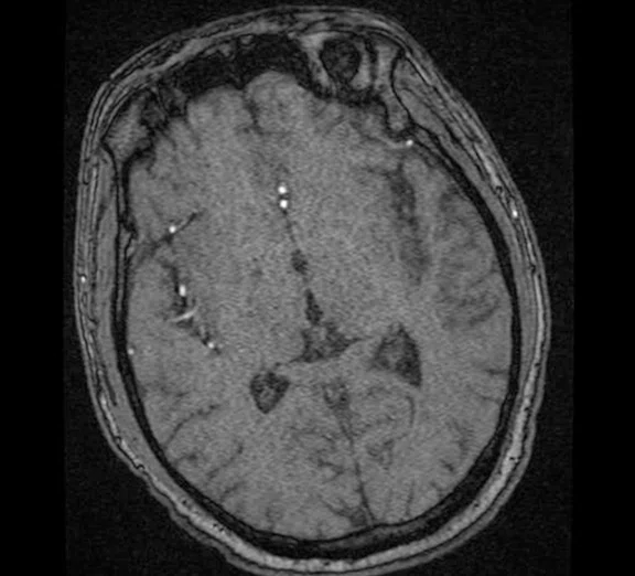 CS_3D ASL stroke_image4 Fig 1D.jpg