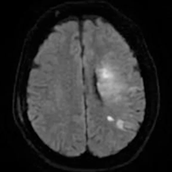 CS_3D ASL stroke_image6 Fig 1E.jpg