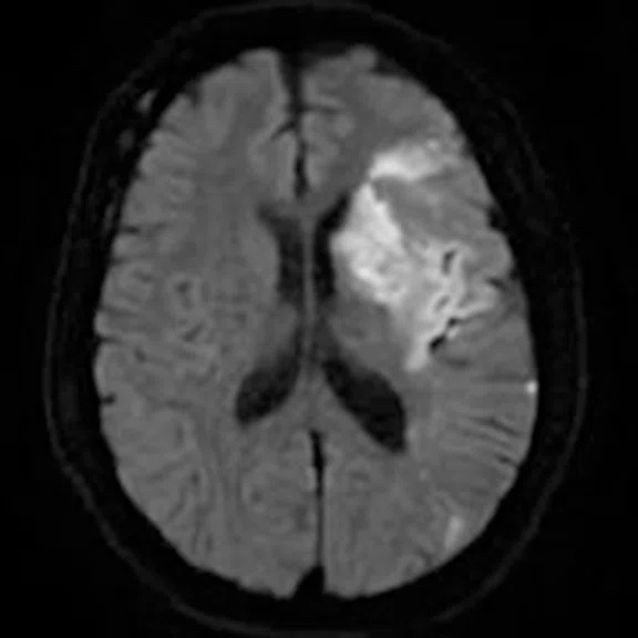 CS_3D ASL stroke_image5 Fig 1F.jpg