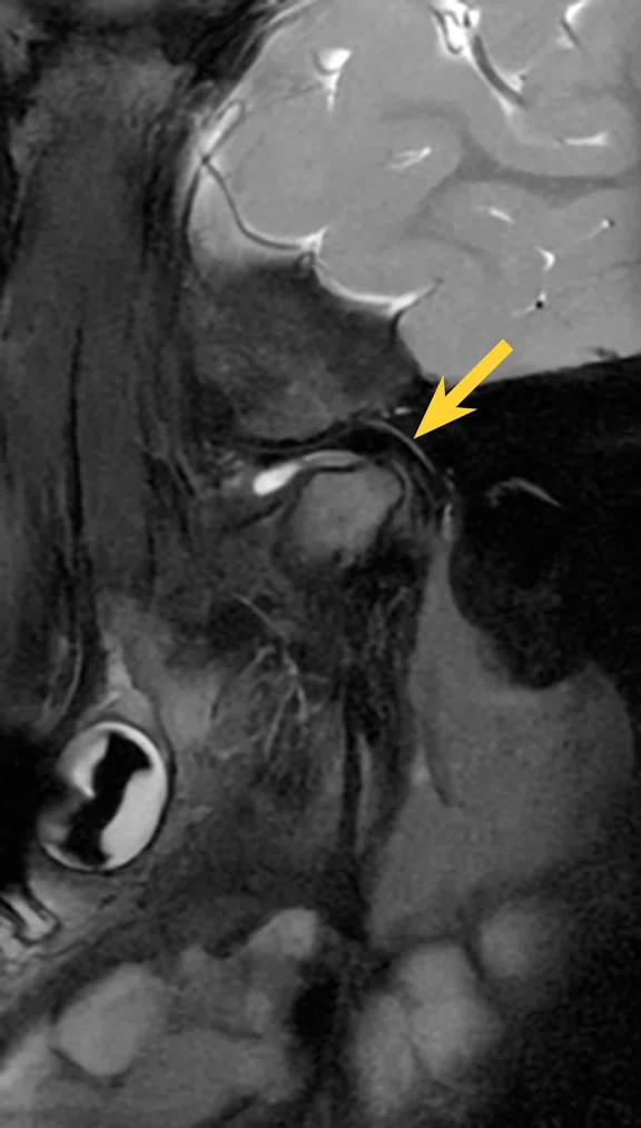 CS_Pediatric kidney TMJ_Zurich_image4 FIg 1A.jpg