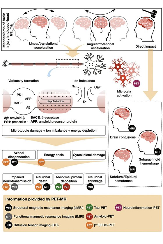 PET-MR_TBI - Figure 1 - Image A.jpg