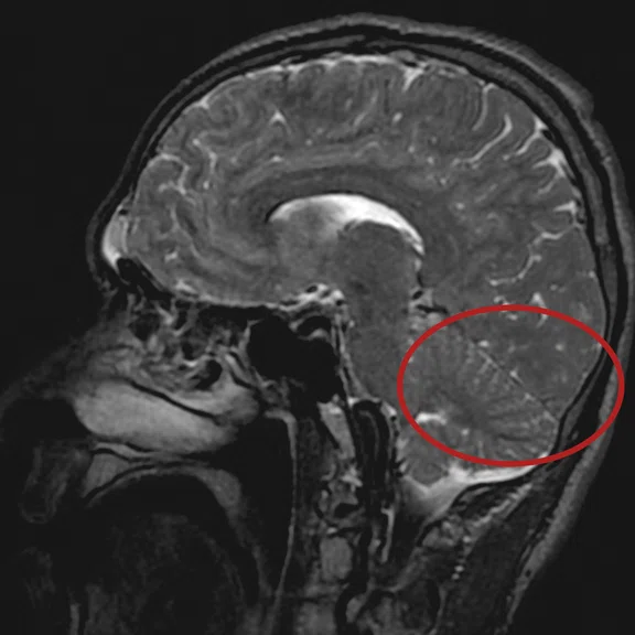 IS_Case_Study_Brain_Figure_5_Image_A.jpg