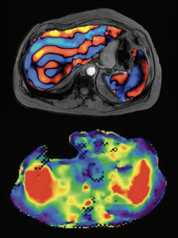 MRE and Liver Disease Figure 5.jpg